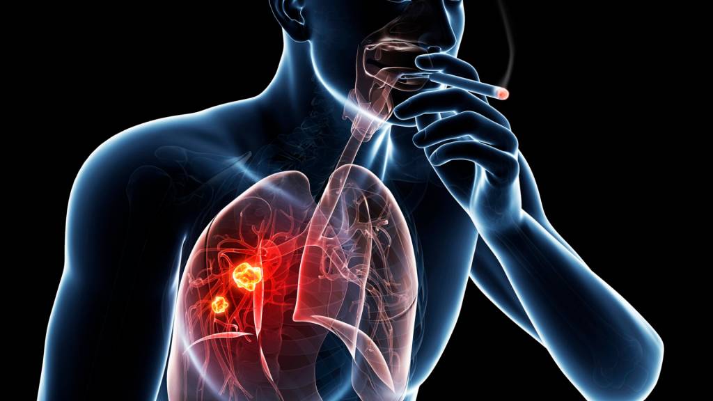 New tech to aid screening and monitoring of lung diseases