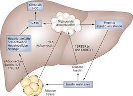 Study offers potential diagnostic and therapeutic tools for fatty-liver-induced diabetes