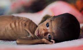 कुपोषण : किशोरावस्था में गर्भधारण से सीधा रिश्ता