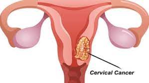 सर्वाइकल कैंसर” से मौत और भारत